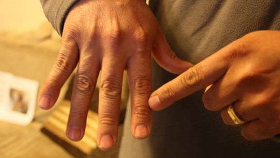 Un metge s’enfronta a 2 anys de presó per operar per error un dit sa